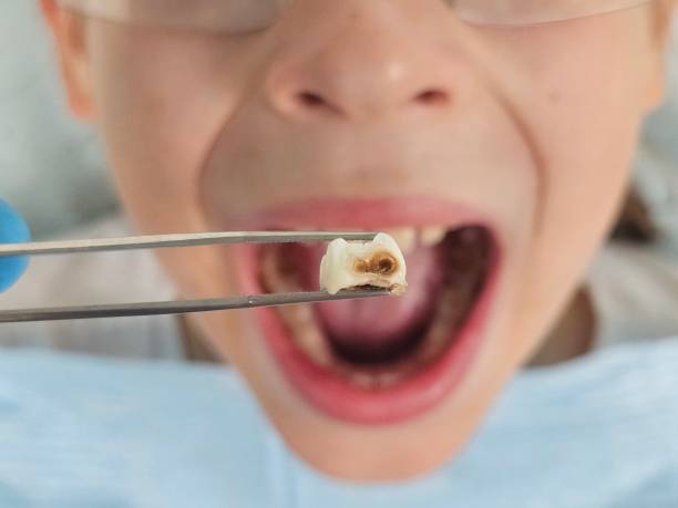 Best Emergency Dentist for Knocked-Out Tooth in Versailles, OH